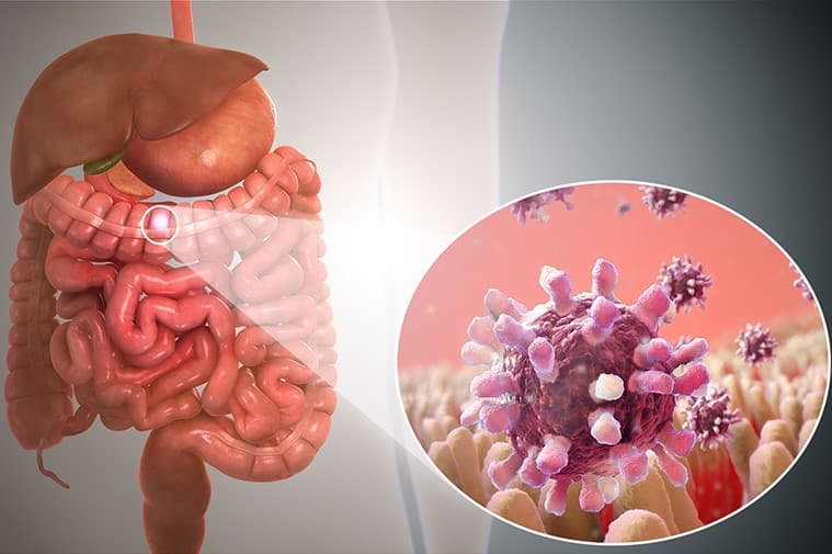 Viral Gastroenteritis