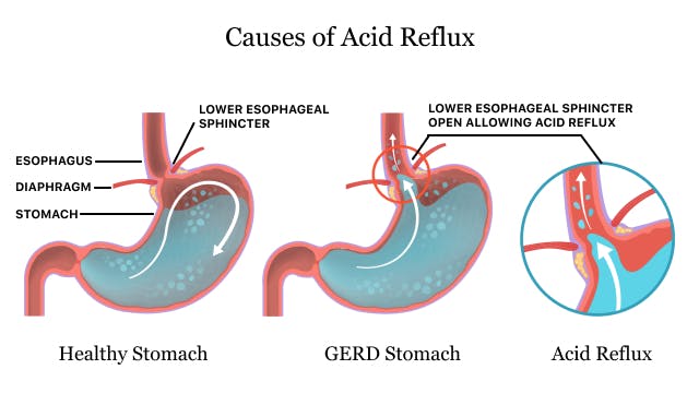 Do You Suffer From GERD, Heartburn, Or Acid Reflux?